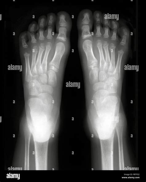Xray Normal Foot