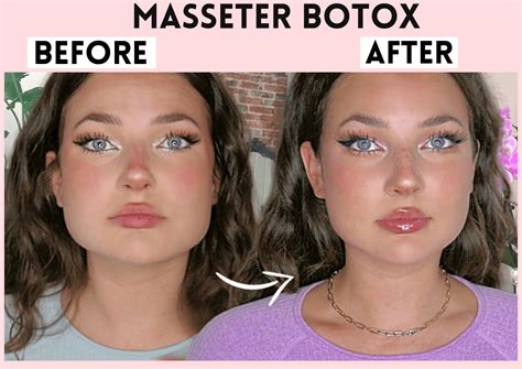 What is Masseter Botox - the daily glimmer