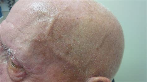 Temporal Arteritis Biopsy and Treatment