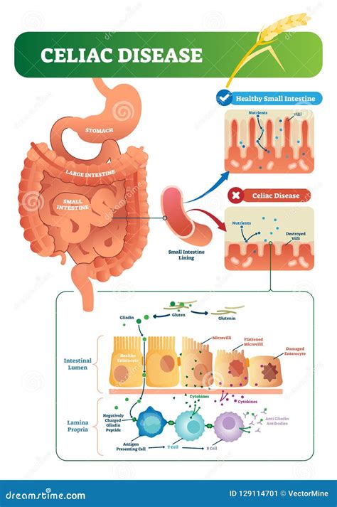 Animal Model Of Celiac Disease at Mary Duckworth blog