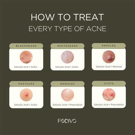 Combat acne like a pro with our dermatologist-recommended formulas. Clear skin is just a step ...