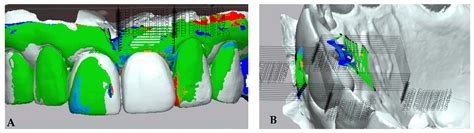Effect of Customized and Prefabricated Healing Abutments on Peri ...