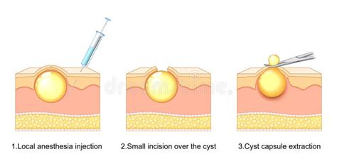 Image result for Cyst Extraction Videos