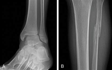 Imaging of the Foot and Ankle - Clinical Tree