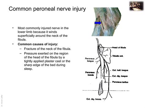 Applied anatomy common peroneal nerve injury | PPT
