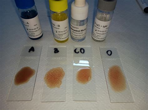 HEMATOLOGIA: PRACTICA 5: TIPIFICACIÓN DEL GRUPO SANGUÍNEO.