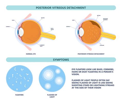 Image result for Eye Floater Types