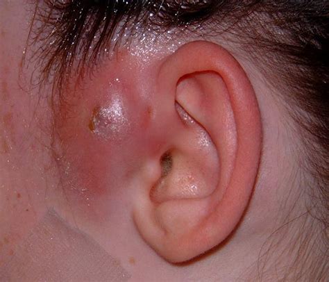 Image result for boils cysts abscesses exploding