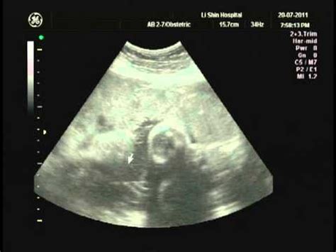 35 Weeks Fetus Ultrasound