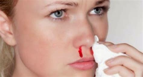 鼻出血的正确止血方法，你学会了吗？ - 知乎