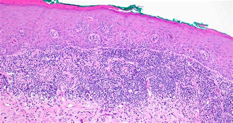Erosive Lichen Planus Histology