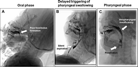 Evaluation of feeding difficulties using videofluoroscopic swallow ...