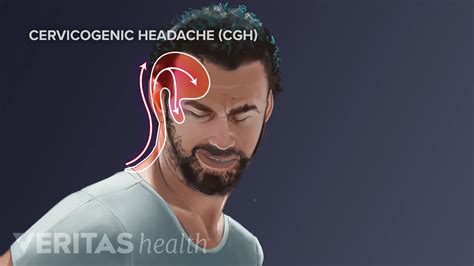 Neck Pain and Cervicogenic Headache | Spine-health