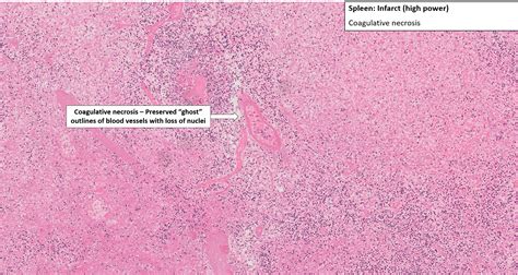 Spleen - Infarct - NUS Pathweb :: NUS Pathweb