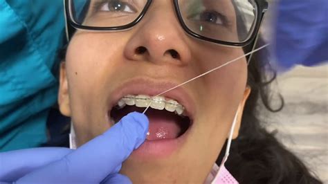 Image result for Using a Floss Threader