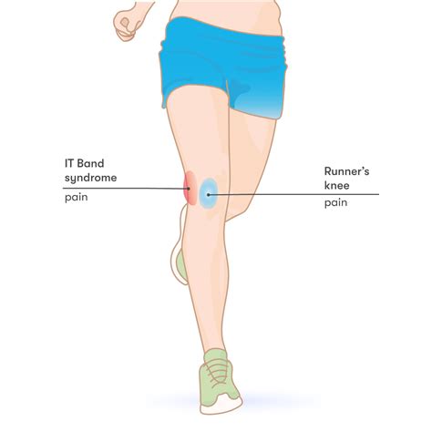 Recommendation Tips About How To Help Runners Knee - Effectsteak33