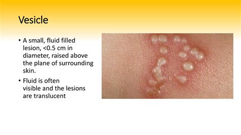 Basic skin lesions | PPTX