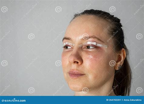 Woman Face after Plastic Surgery, Blepharoplasty Operation, Swelling Eye Bags, Incisions with ...