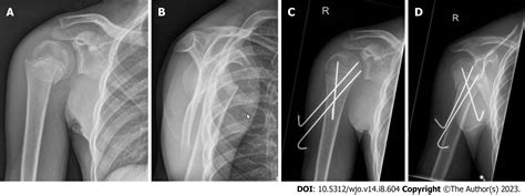 Fractures around the shoulder in the skeletally immature: A scoping review