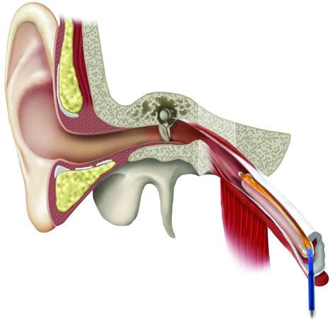 Eustachian Tube Dilation Surgery Recovery Time at Fernando Ward blog