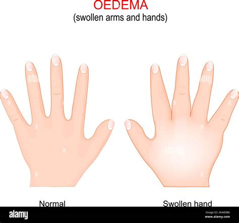 Edema. Swollen arms and hands. oedema is the build-up of fluid in the body's tissue. Vector ...