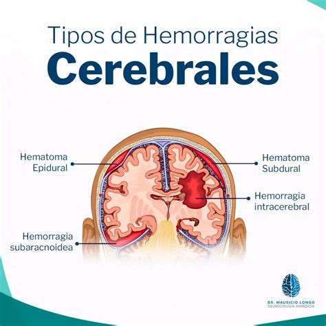 Hemorragia Epidural
