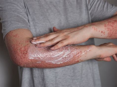 Will Psoriasis Ever Go Away? Exploring Causes, Long-Term Remission ...
