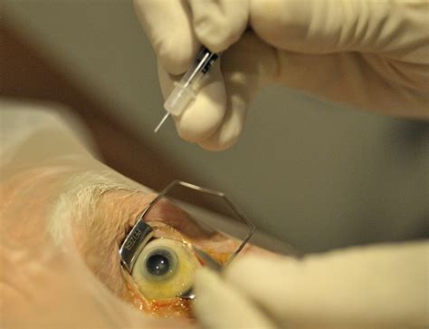 Eye Injection 的图像结果
