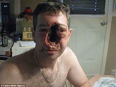 trou peau visage homme les photos insoutenables d un homme qui a eu un cancer du trou peau visage homme les photos insoutenables d un homme qui a eu un cancer du