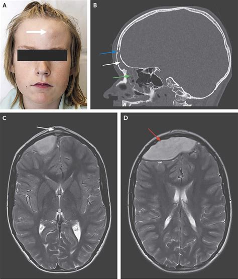 Pott's puffy tumor causes, symptoms, diagnosis & treatment