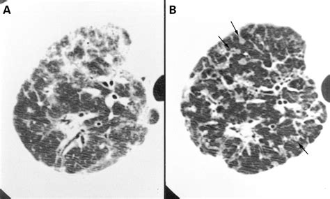 Non-specific interstitial pneumonia: findings on sequential CT scans of nine patients | Thorax
