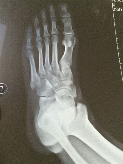 我左脚崴了去医院拍了个片子，检查报告上症状无异常，但是医生看了片子说是第五跖骨基底骨折需要打石膏固_百度知道