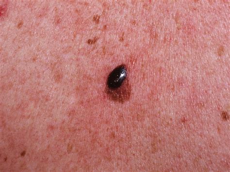 Skin Cancer - Types, Symptoms - Melanoma & Treatment