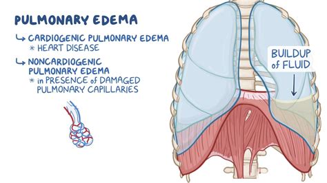 Noncardiogenic Pulmonary Edema Cxr
