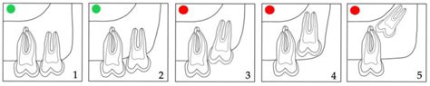 Eruption Pattern of Third Molars in Orthodontic Patients Treated with ...