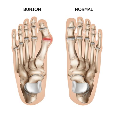 Natural Non-Surgical Bunion and Bunionette Treatment at Vancouver Orthotic - Vancouver Orthotic ...