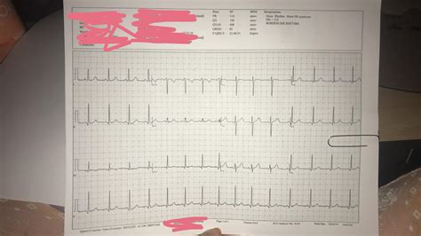Anyone Experience Similar Symptoms/Events? : dysautonomia