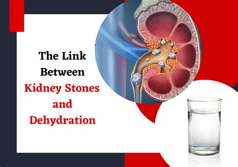Kidney Stones Flush Water at Glenn Barbee blog