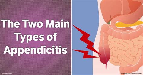 Image result for Different Types of Appendicitis