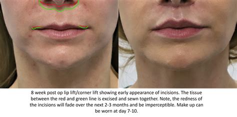 Corner Lip Lift Surgery Before And After Pictures San Jose - Infoupdate.org