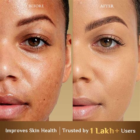 Richfeel Calendula Anti Acne Soap 75 g – richfeelnaturals.com