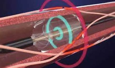 FDA panel backs ultrasound-based renal denervation system for ...