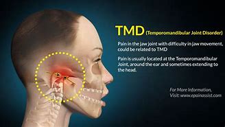 temporomandibular 的图像结果
