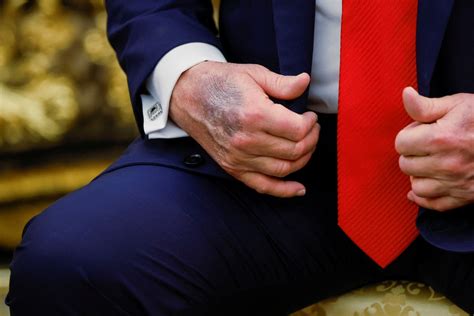 "Superstitious" Trump says higher aspirin dosage behind hand bruises