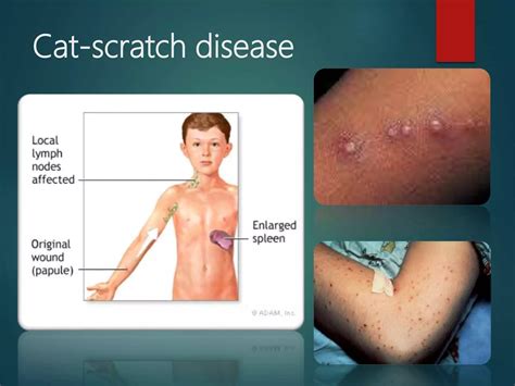 Cat scratch disease | PPTX