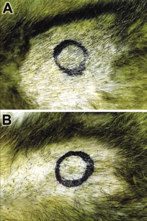 Normal Hair Density 的图像结果