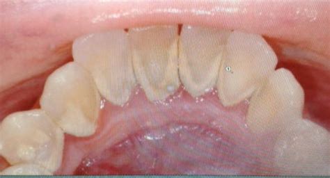 Image result for Bottom Teeth Calcium Buildup