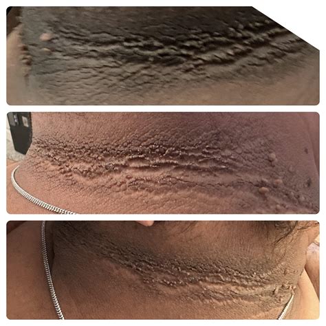 Skin Tags On Neck