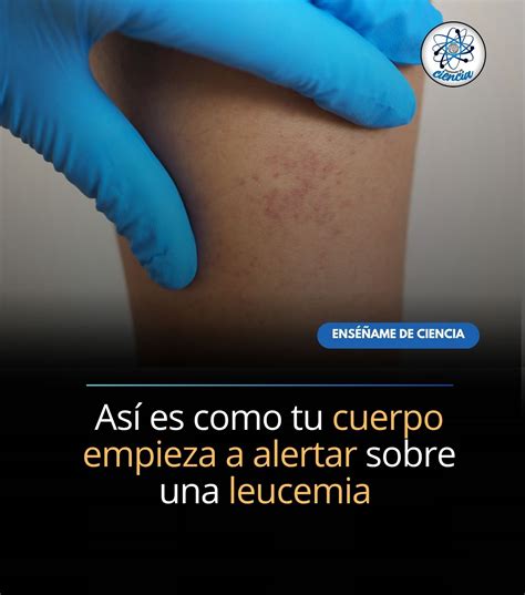Leucemia: así son los principales SÍNTOMAS que delatan este tipo de cáncer - INICIO