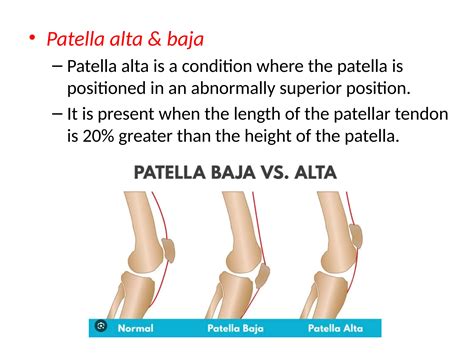 PHYSIOTHERAPY MANAGEMENT FOR CHONDROMALACIA PATELLA.pptx